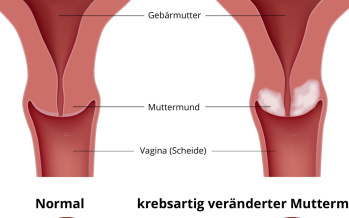 Gebärmutterhalskrebs