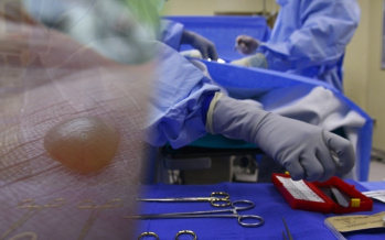 Genitalwarzen