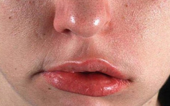 Gesichtsnervlähmung