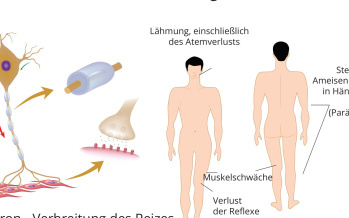 Guillain-Barré-Syndrom