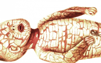 Hautkrankheit Harlekin