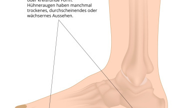Hühnerauge