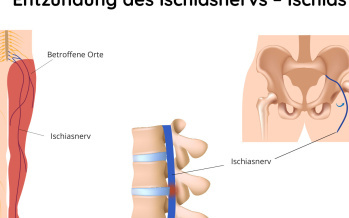 Ischias