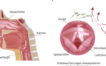 Kehlkopfkrebs