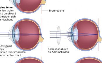 Kurzsichtigkeit