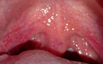 Laryngitis