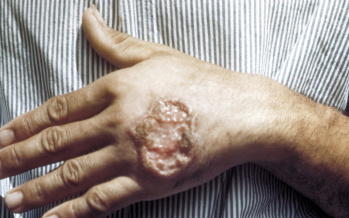 Leishmaniose