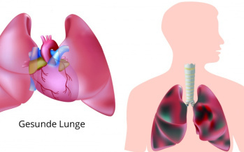 Lungenpest