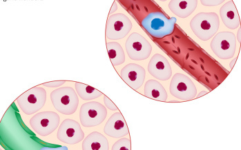 Lymphknotenkrebs