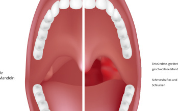 Mandelentzündung - Tonsillitis