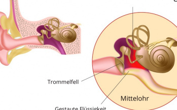 Mastoiditis