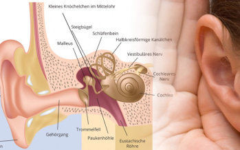Menière-Krankheit