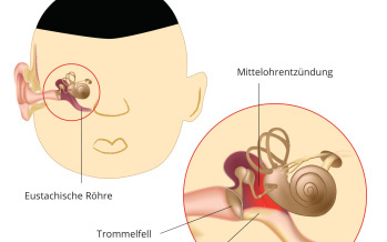 Mittelohrentzündung