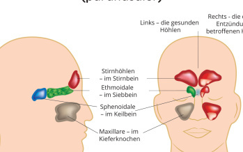 Nasennebenhöhlenentzündung