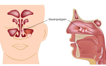 Nasenpolypen