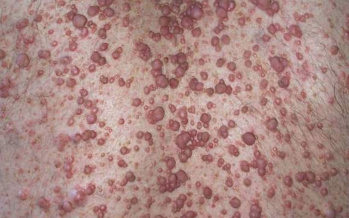 Neurofibromatose