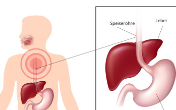 Ösophagitis