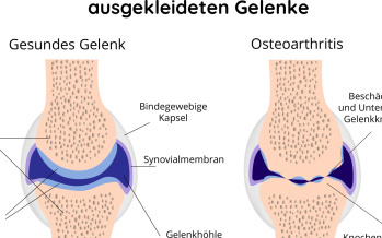 Osteoarthrose