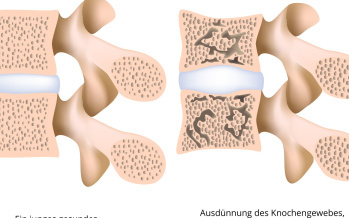 Osteoporose der Lendenwirbelsäule