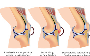 Patellatendinitis