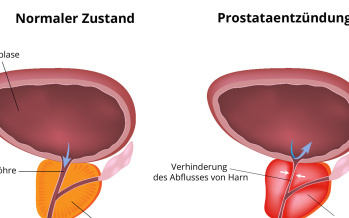 Prostataentzündung