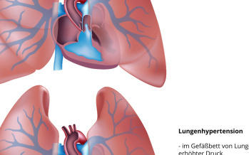 Pulmonale Hypertonie