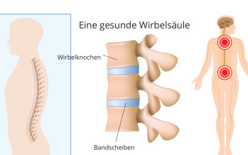 Radikulopathie