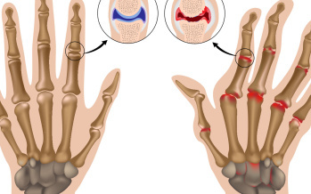 Rheumatoide Arthritis der Fingergelenke