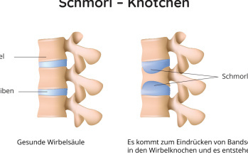 Schmorl - Knötchen