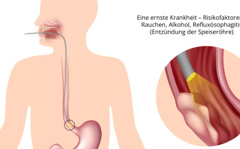 Speiseröhrenkrebs