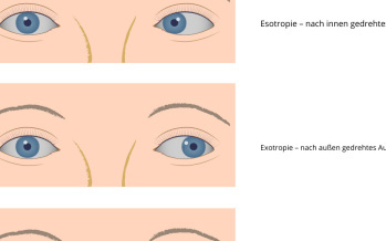Strabismus - Schielen