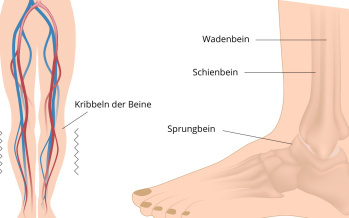 Syndrom der ruhelosen Beine