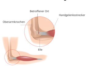 Tennisellenbogen