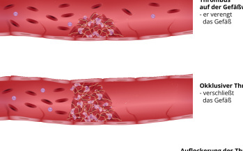 Thrombose