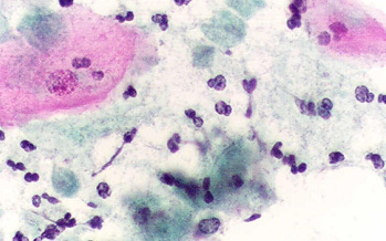 Trichomoniasis
