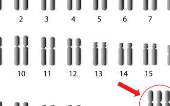 Triple-X-Syndrom