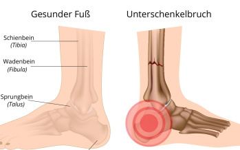 Unterschenkel-, und Knöchelbruch