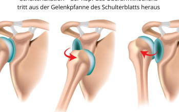 Die verrenkte Schulter