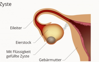 Zyste