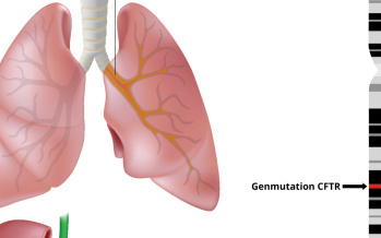 Zystische Fibrose
