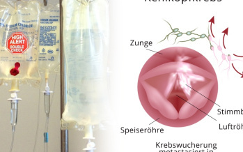 Krebsmedikamente und Antihistaminika