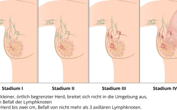Brustkrebs