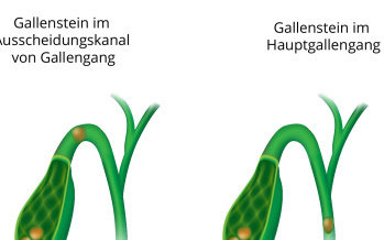 Gallenkolik