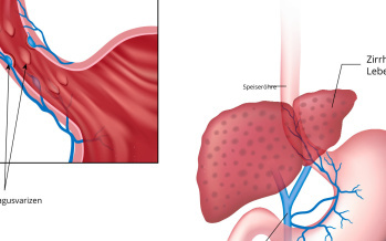 Ösophagusvarizen