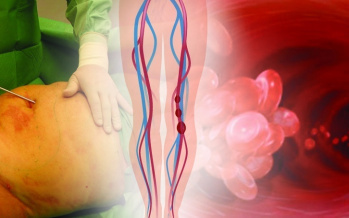 Risiken der Liposuktion