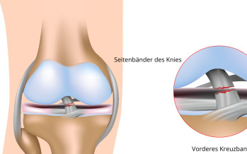 Riss des vorderen Kreuzbandes