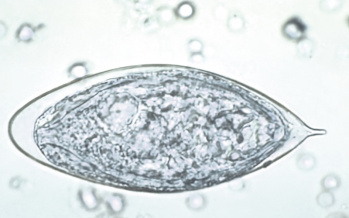 Schistosomiasis