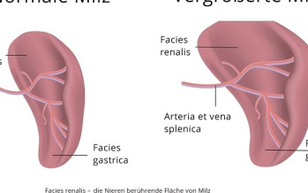 Milzvergrößerung