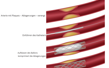 Angioplastie