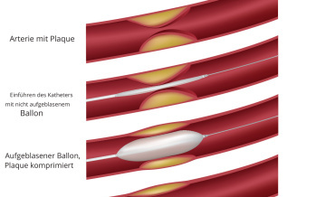 Ballonangioplastie